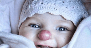 Преди 9 години това чаровно момиче се роди с „клоунски нос“! Как живее и как изглежда днес