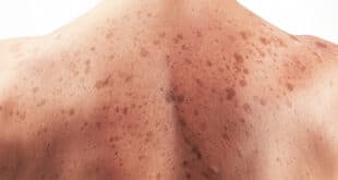 Не ги пренебрегвайте: 4 симптома, които издават ракa на кожата